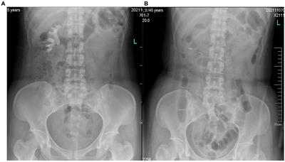 Retrograde intrarenal surgery with intelligent control of renal pelvic pressure for staghorn calculi: a case report